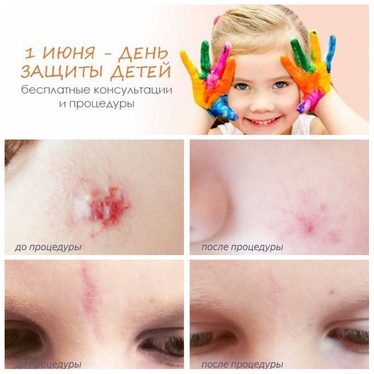 Акция Линлайн